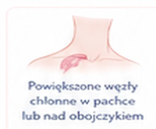 Powiększone węzły chłonne